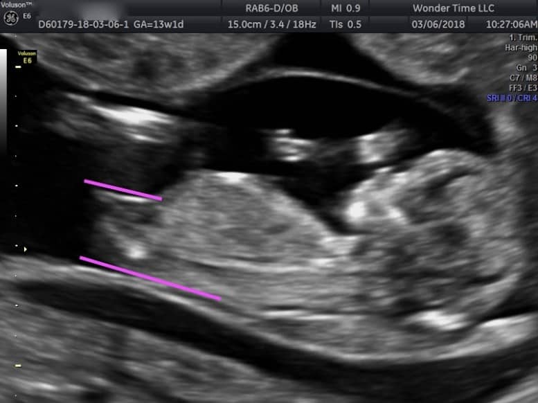 Can You Tell Gender At 13 Weeks 3 Days Gender Ultrasound Wondertime Llc